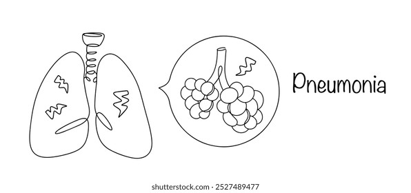 Pneumonia. Inflammation of the lung tissue is usually of infectious origin with predominant damage to the alveoli. Medical vector isolated on white background.