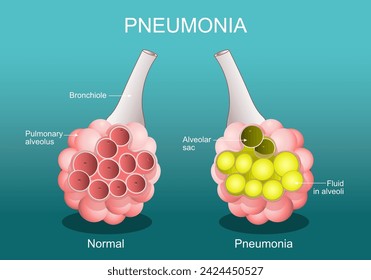 Lungenentzündung. Entzündlicher Zustand der Lunge. Der Querschnitt der normalen Alveolen und Alveolen ist mit Flüssigkeit gefüllt. Vektor-Poster. In: Isometric Flat Illustration.