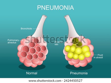 Pneumonia. Inflammatory condition of the lungs. Cross section of normal alveolus, and Alveoli are filled with fluids. Vector poster. Isometric Flat illustration.
