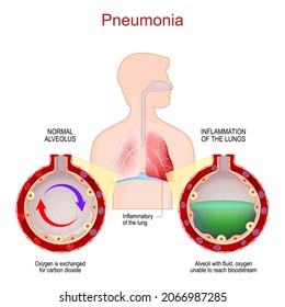 Pneumonia. Lung infection. Inflammatory of the respiratory system. Close-up of healthy alveolus and Alveoli with fluid, where oxygen unable to reach bloodstream. comparison and difference. Vector