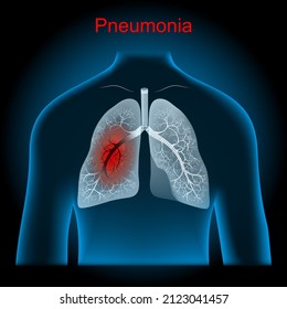 Asthma Chronic Inflammatory Disease Airways That Stock Illustration ...