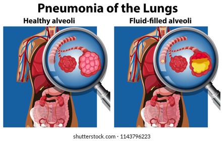 Pneumonia of the lungs concept illustration