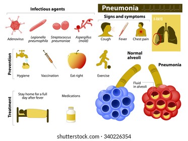 Pneumonia. Medical Infographic set with icons and other elements. medical symbols for design