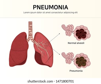 6,295 Alveoli Images, Stock Photos & Vectors | Shutterstock