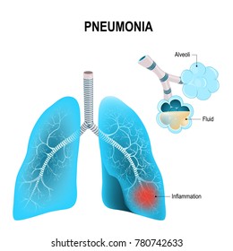 Pneumonia. Normal and inflammatory condition of the lung, and inflamed alveoli with fluid.