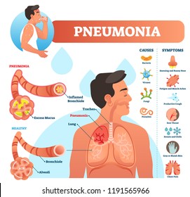 Pneumonia vector illustration. Labeled diagram with causes and symptoms. Medical closeup and isolated lung and respiratory system structure. Sneezing and cough reason.