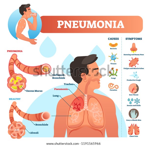 Pneumonia vector illustration.\
Labeled diagram with causes and symptoms. Medical closeup and\
isolated lung and respiratory system structure. Sneezing and cough\
reason.