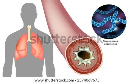 Pneumoniae Bacteria and Human Respiratory System Illustration. Microscopic View of Streptococcus. Bacterial Infection in the Lungs