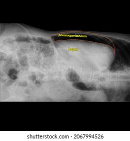 Pneumoperitoneum Free Air Abdomen X Ray Stock Vector (Royalty Free Pneumoperitoneum Free Air Abdomen X Ray Stock Vector (Royalty Free