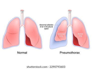 Pneumothorax. accumulation of air between the lung and the chest cavity. Normal, and collapsed lungs. Human Respiratory system. Vector illustration 