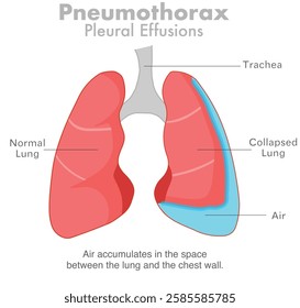 Pneumothorax, air in the lungs or collapsed lung.   Pleural effusions, respiratory system diseases. Vector illustration