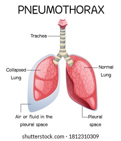 Pneumothorax cartoon of human anatomy illustration