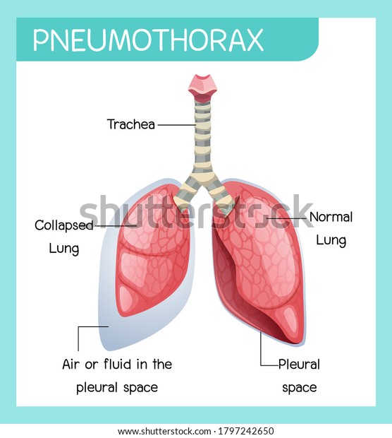 Pneumothorax Cartoon Human Anatomy Illustration Stock Vector (Royalty ...