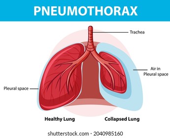 Pneumothorax Diagram Collapsed Lung Healthy Lung Stock Vector (Royalty ...