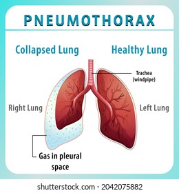 Pneumothorax Diagram Collapsed Lung Healthy Lung Stock Vector (Royalty ...