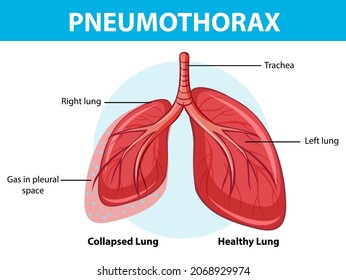 Pneumothorax Diagram Collapsed Lung Healthy Lung Stock Vector (Royalty ...