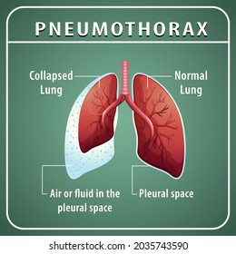 Pneumothorax diagram with collapsed lung and normal lung illustration