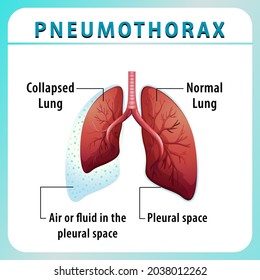 Pneumothorax Diagram Collapsed Lung Normal Lung Stock Vector (Royalty ...