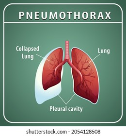 Diagrama de neumotórax con pulmón colapsado e ilustración pulmonar normal