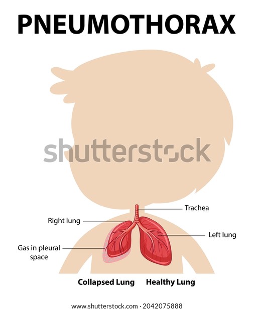 Pneumothorax Diagram Human Anatomy Illustration Stock Vector Royalty