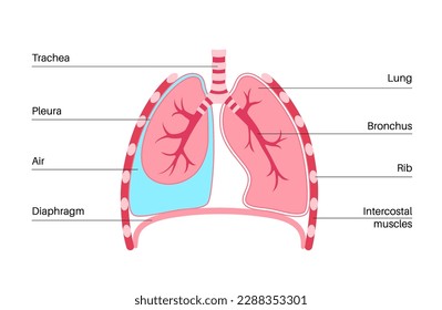 Pneumothorax disease flat vector. Collapsed lung medical poster. Air in the space between lung and chest wall. Chest pain, shortness of breathing. Unhealthy internal organs in respiratory system