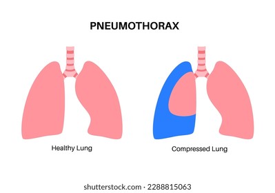Pneumothorax disease flat vector. Collapsed lung medical poster. Air in the space between lung and chest wall. Chest pain, shortness of breathing. Unhealthy internal organs in respiratory system