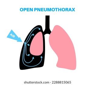 Pneumothorax disease flat vector. Collapsed lung medical poster. Air in the space between lung and chest wall. Chest pain, shortness of breathing. Unhealthy internal organs in respiratory system