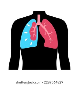 Pneumothorax disease flat vector. Collapsed lung medical poster. Air in the space between lung and chest wall. Chest pain, shortness of breathing. Unhealthy internal organs in respiratory system