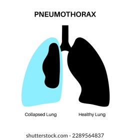 Pneumothorax disease flat vector. Collapsed lung medical poster. Air in the space between lung and chest wall. Chest pain, shortness of breathing. Unhealthy internal organs in respiratory system