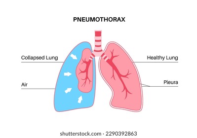 Pneumothorax disease flat vector. Collapsed lung medical poster. Air in the space between lung and chest wall. Chest pain, shortness of breathing. Unhealthy internal organs in respiratory system