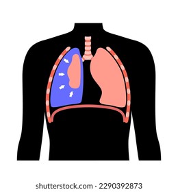 Pneumothorax disease flat vector. Collapsed lung medical poster. Air in the space between lung and chest wall. Chest pain, shortness of breathing. Unhealthy internal organs in respiratory system