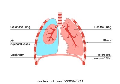 Pneumothorax disease flat vector. Collapsed lung medical poster. Air in the space between lung and chest wall. Chest pain, shortness of breathing. Unhealthy internal organs in respiratory system