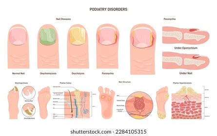 Podiatry diseases set. Feet and nails disorders or medical condition. Dermatology disorder. Flat vector illustration