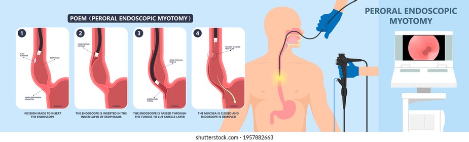 POEM Per oral surgery treat surgical GERD tract lower food damage nerves acid reflux pain barium swallow motility balloon diffuse spasm outflow upper biopsy heller