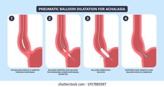 POEM Per oral surgery treat surgical GERD tract lower food damage nerves acid reflux pain barium swallow motility balloon diffuse spasm outflow upper biopsy heller