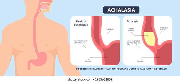 POEM Per Oral Surgery Treat Surgical GERD Tract Lower Food Damage Nerves Acid Reflux Pain Barium Swallow Motility Balloon Diffuse Spasm Outflow Upper Biopsy Heller