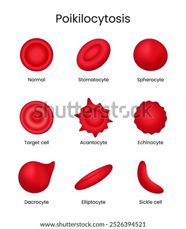 Poikilocytosis Abnormal Variation in Shape