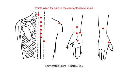 Points used for pain in the cervicothoracic spine