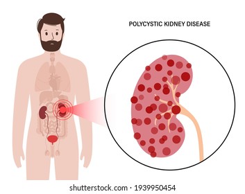Polycystic in human kidney. Adult man has pain and inflammation in the urinary system. Inflammation in the human body. Anatomical medical poster for clinic. Internal organs examination concept.