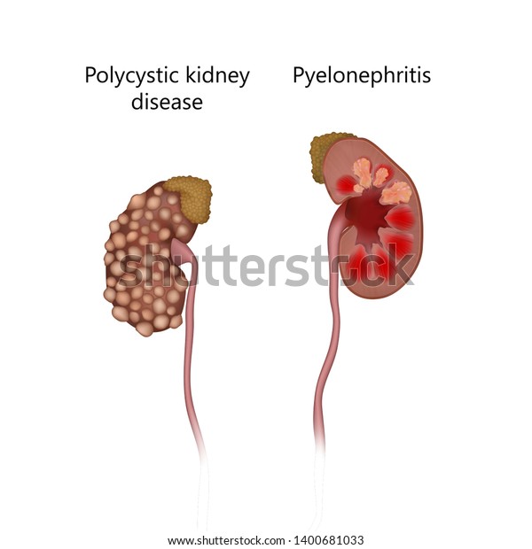 Polycystic Kidney Disease Comparison Pyelonephritis Infection Stock ...