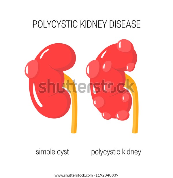 Polycystic Kidney Disease Concept Vector Illustration Stock Vector ...