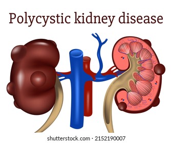 Polycystic Kidney Disease. Genetic Disease. Infographics Of Organs With Cysts. Medical Banner. Vector Illustration