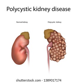 593 Polycystic kidney Images, Stock Photos & Vectors | Shutterstock