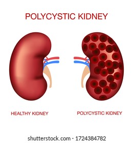 Polycystic Kidney Disease.Normal And Polycystic Kidneys.Realistic Human Organs.