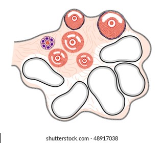 Polycystic ovary