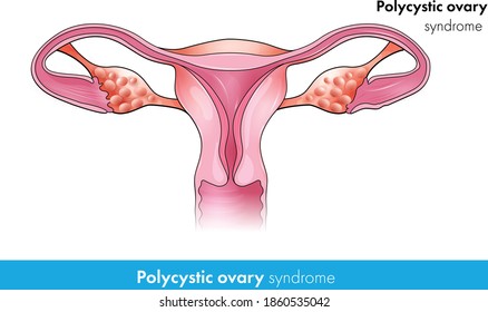 Polycystic Ovary: Hormonal Disorder Of Female Ovaries Vector Design Concept Vector Illustration