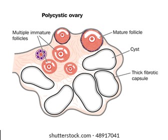 Polycystic ovary -- labeled