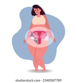 polycystic ovary symptoms, endometriosis. Sad overweight woman with excess body hair. vector illustration.