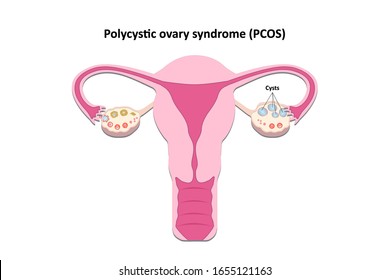 Polycystic ovary syndrome, Female reproductive system diagram