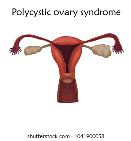 masturbation Polycycstic ovaries